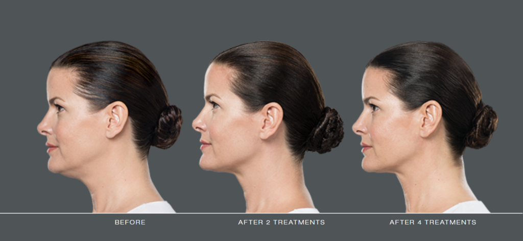 Kybella before and after