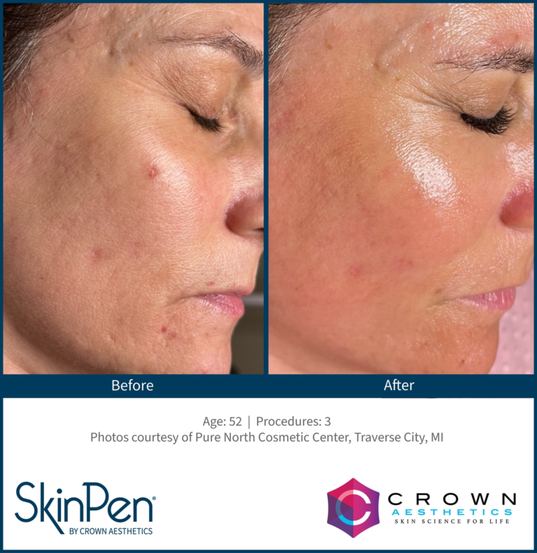 Skinpen before and after