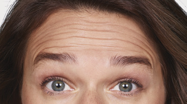 Forehead Lines