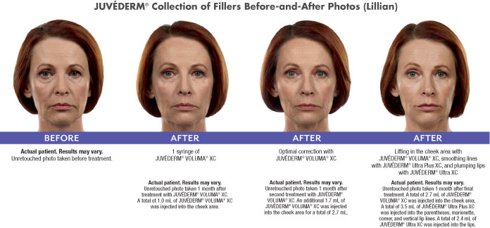 Juvederm Before and After