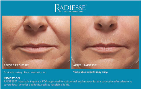 Radiesse Before and After