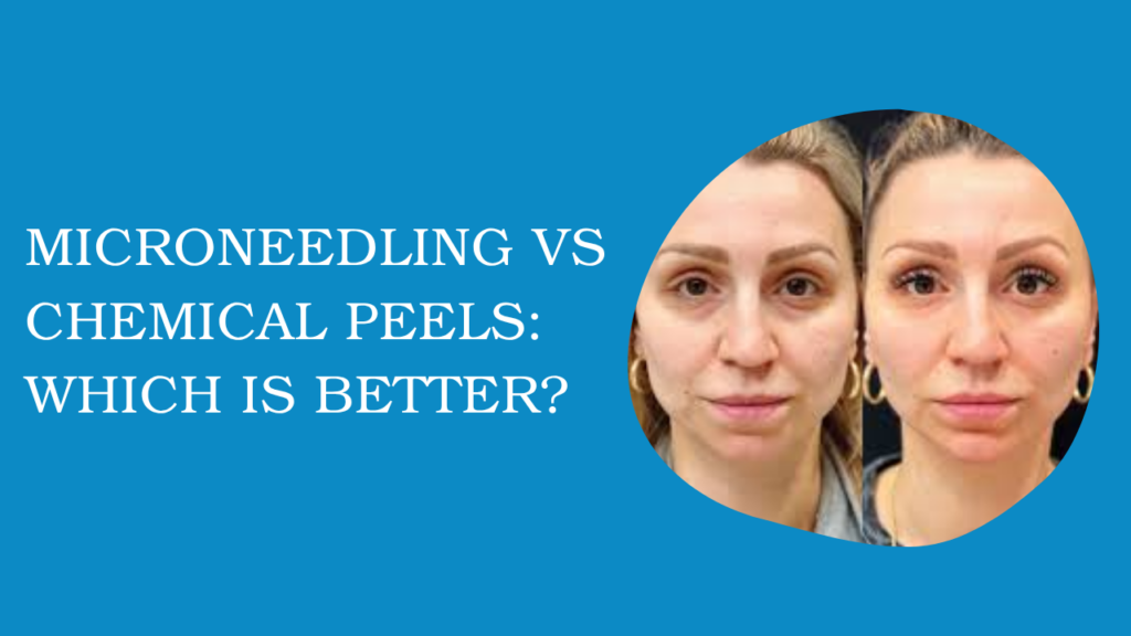 Microneedling vs Chemical Peels