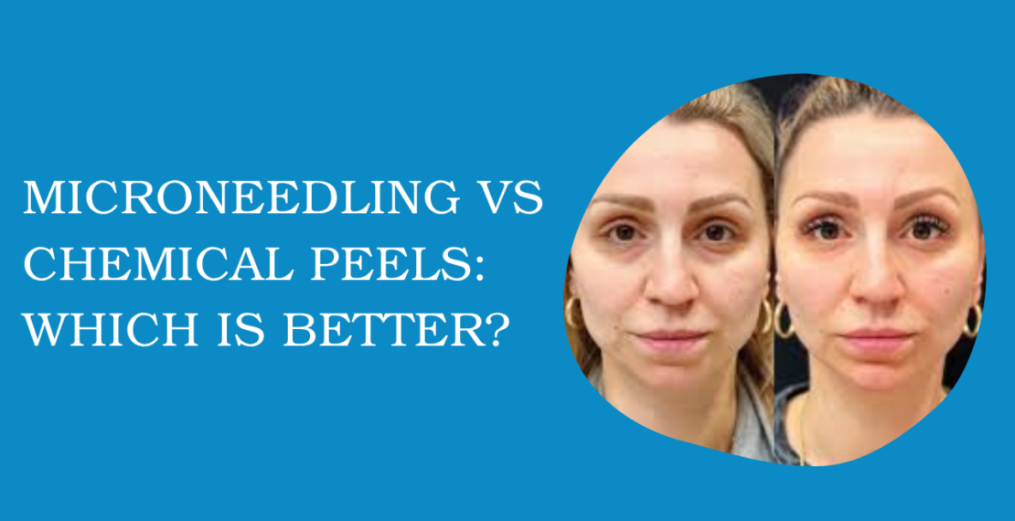 Microneedling vs Chemical Peels: Which Is Better?
